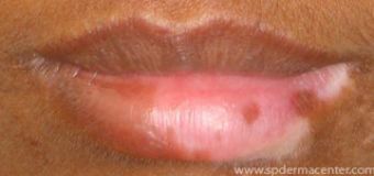 Lip-Vitiligo-Before